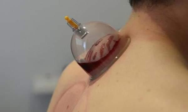 الحجامة، فضل الحجامة، الطب التكميلي
